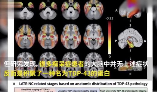 载蛋白a1偏低什么原因_载脂蛋白e_载蛋白a1高有什么危害