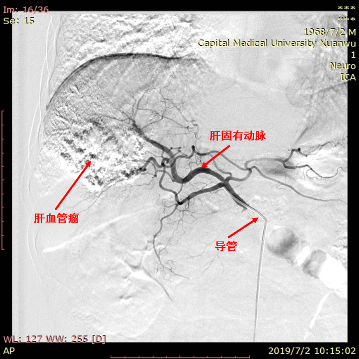 无水乙醇栓塞_乙醇水精馏塔设计_乙醇-水二元筛板精馏塔设计百度文库